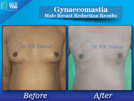 Gynaecomastia before after image